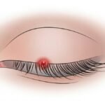 Starting to Get a Stye in Your Eye? Here’s How It’s Commonly Treated